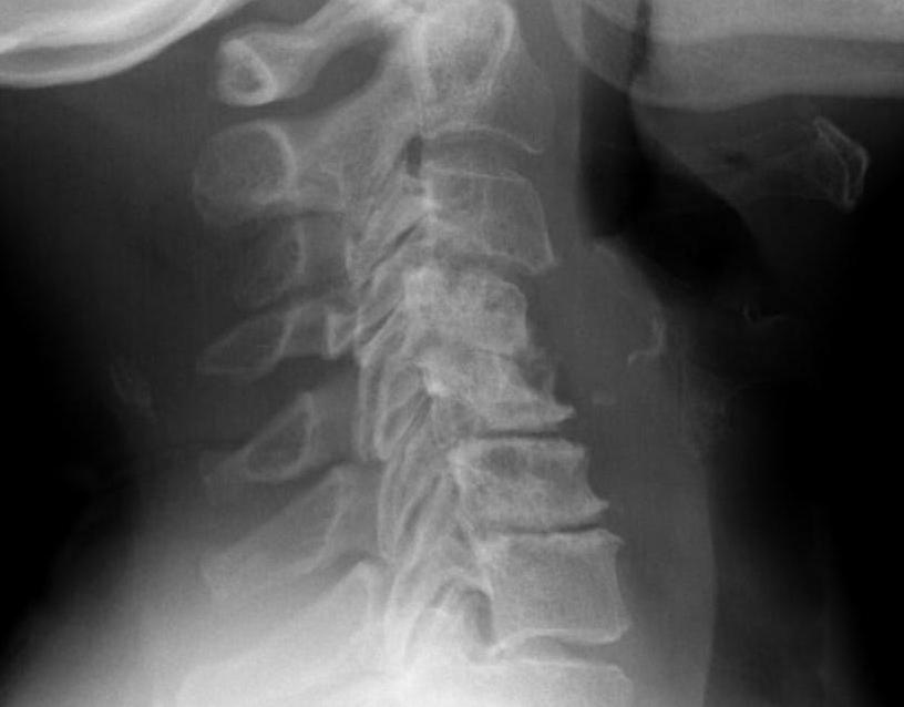 Rheumatoid Arthritis Subaxial Instability Extension View